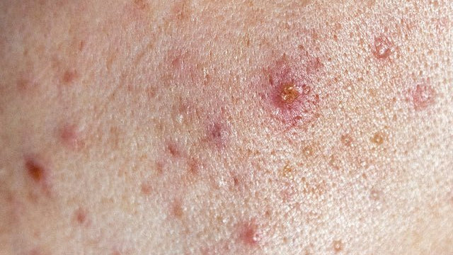 Cosmetic ingredients that help mit acne - Al+ Cosmetics