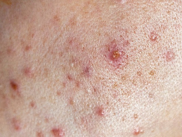 Cosmetic ingredients that help mit acne - Al+ Cosmetics