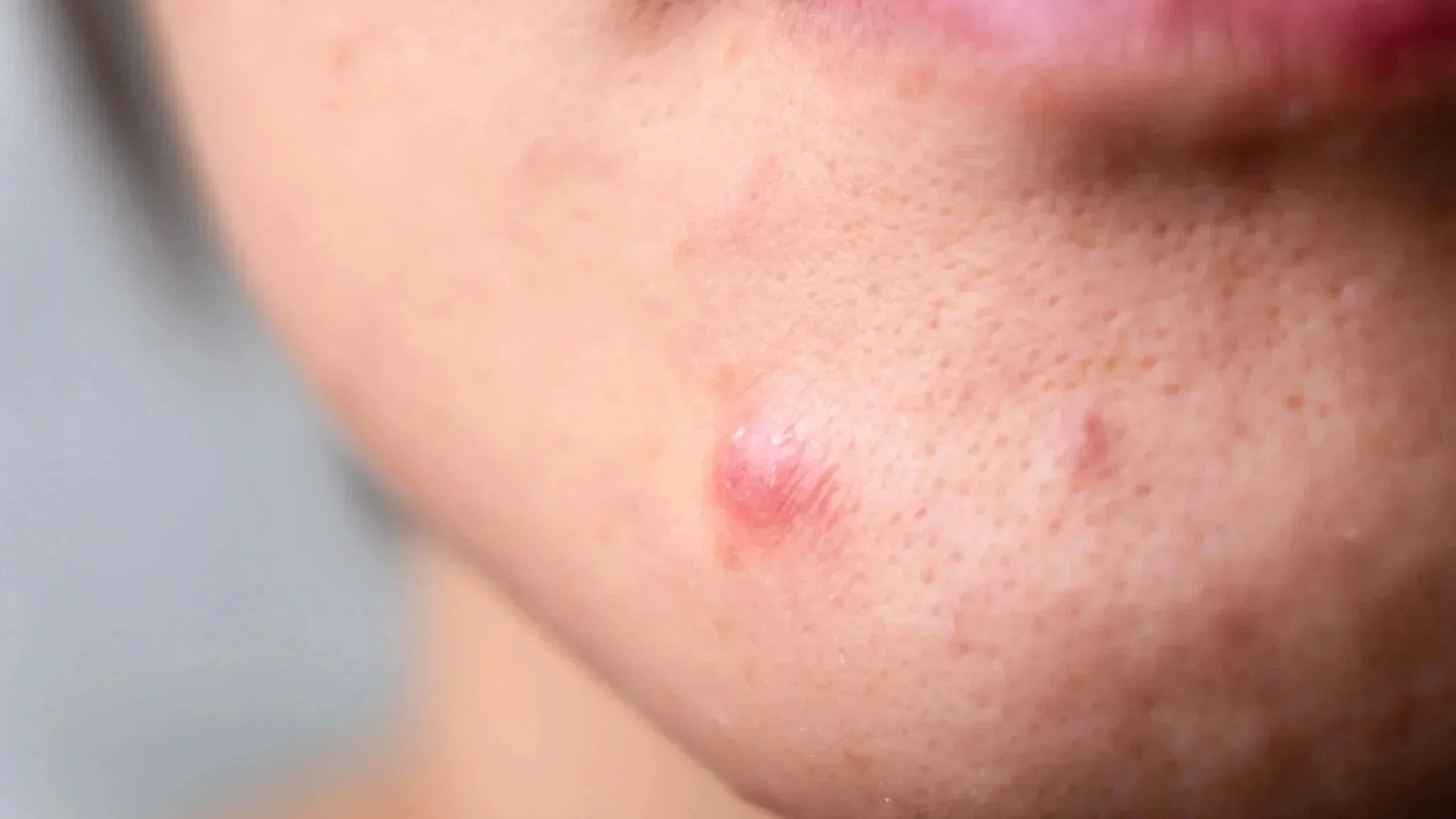 Подкожни пъпки: Защо се появяват и как може да се справим с тях? - Al+ Cosmetics