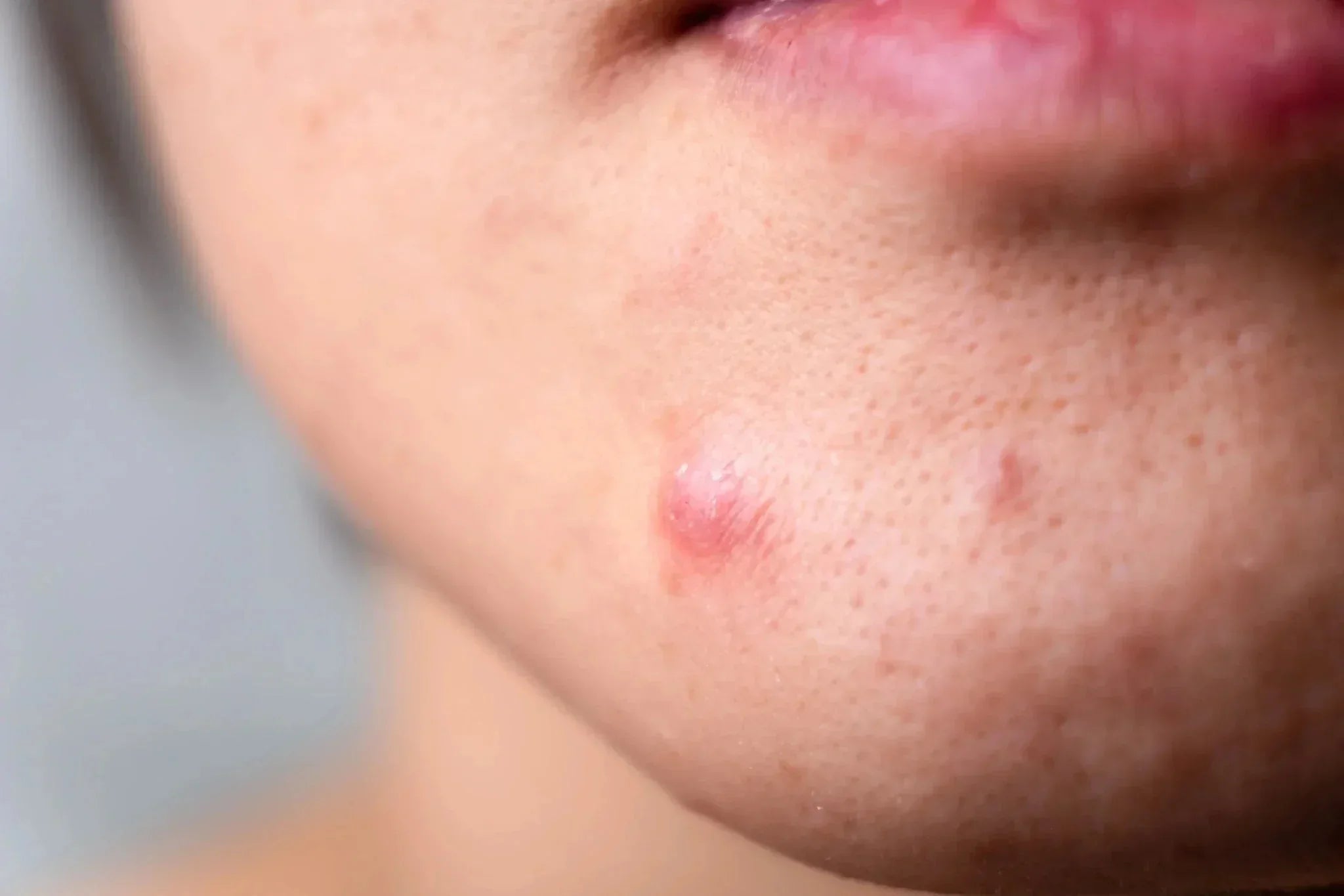 Подкожни пъпки: Защо се появяват и как може да се справим с тях? - Al+ Cosmetics